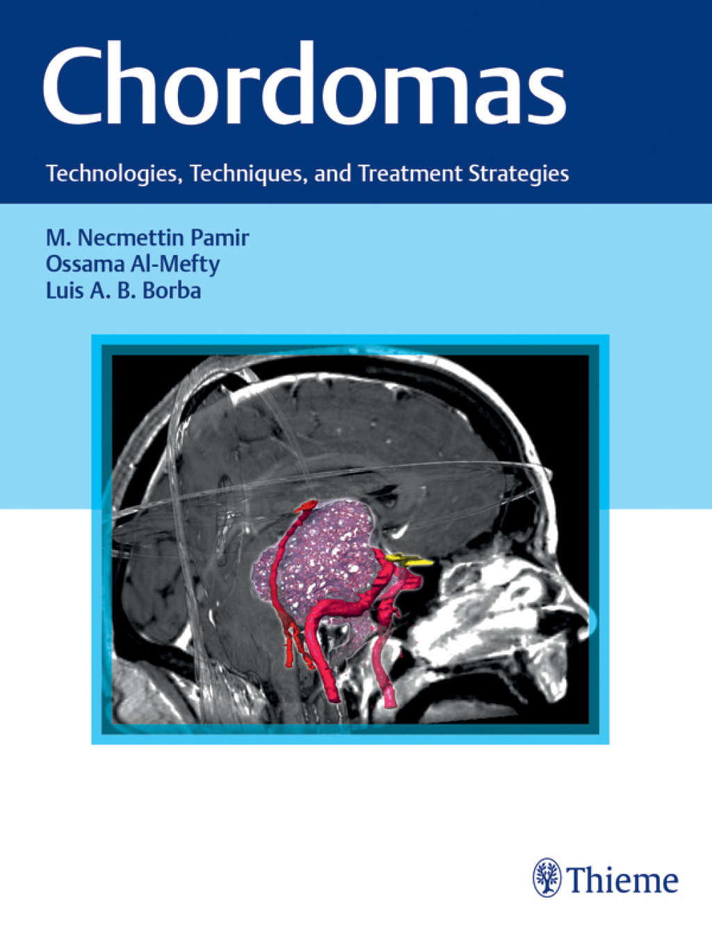 Chordomas Technologies, Techniques, and Treatment Strategies 1st Edition â€“ PDF/EPUB Version Downloadable