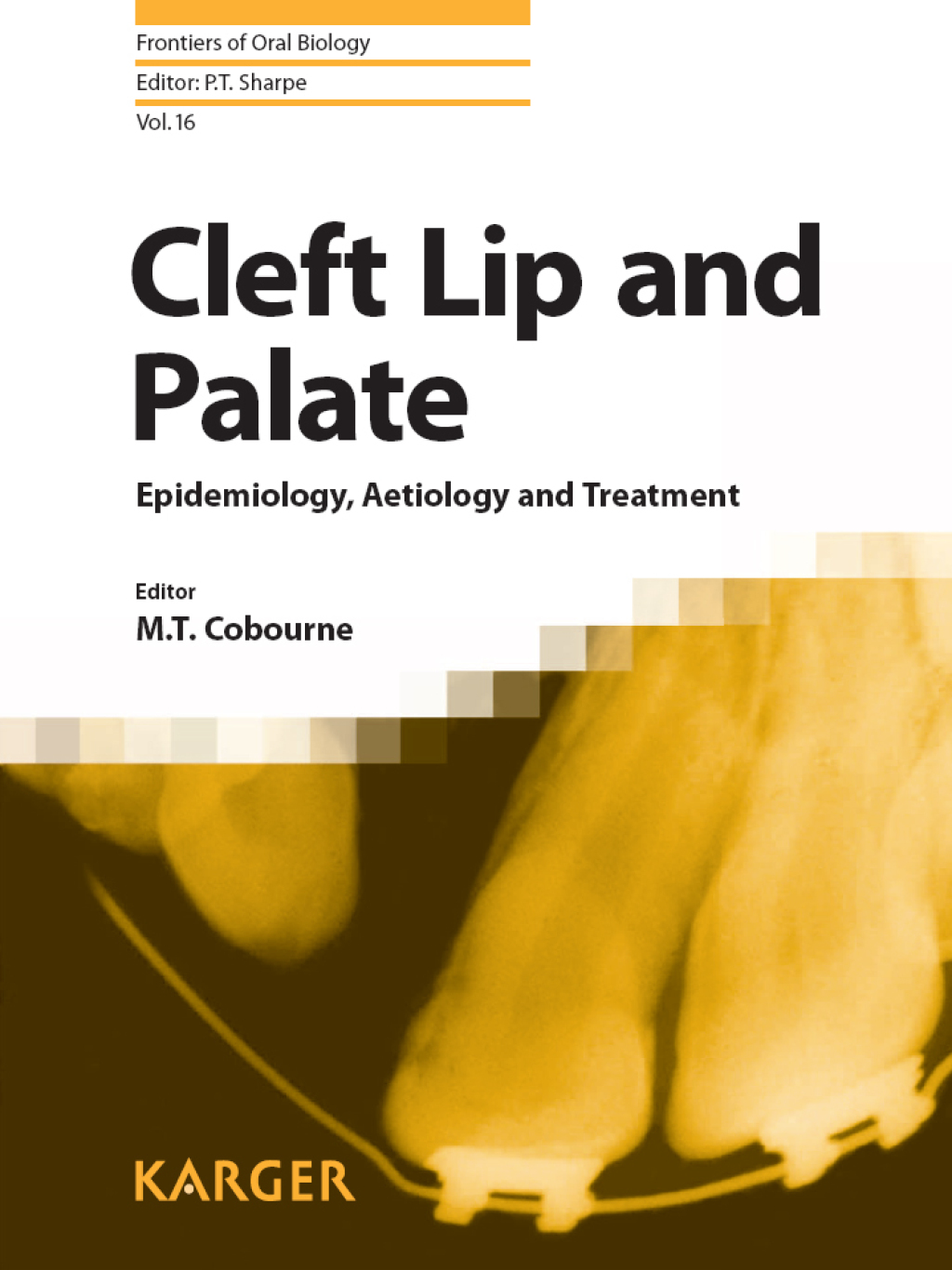 Cleft Lip and Palate Epidemiology, Aetiology and Treatment 1st Edition ...