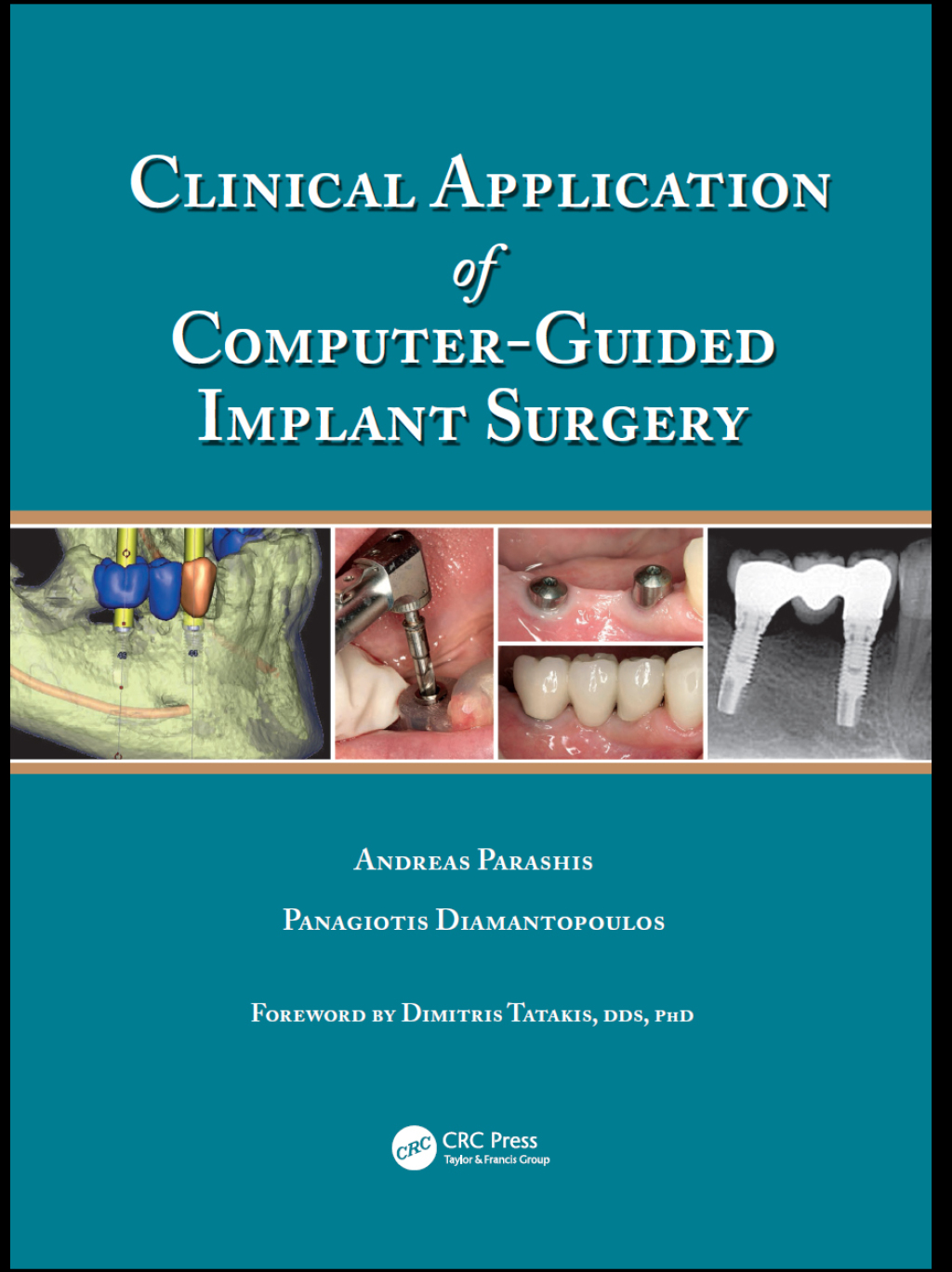 Clinical Application of Computer-Guided Implant Surgery 1st Edition â ...