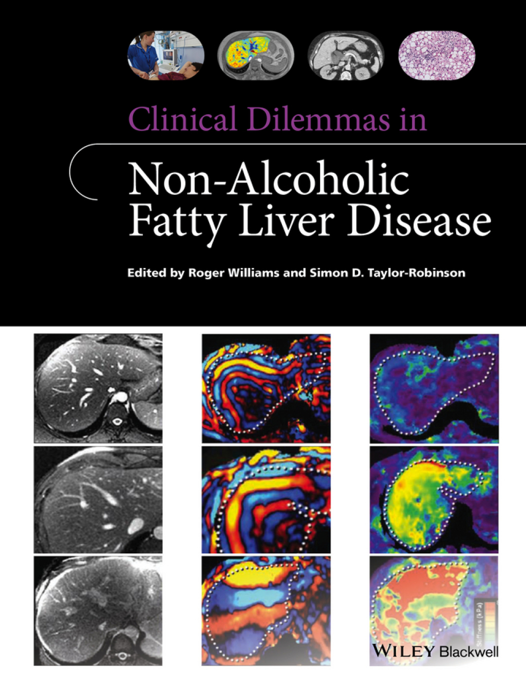 Clinical Dilemmas in Non-Alcoholic Fatty Liver Disease 1st Edition â ...