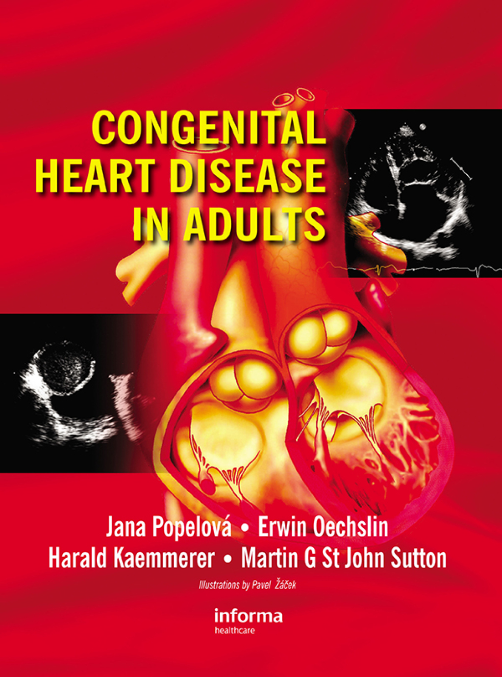 Congenital Heart Disease in Adults 1st Edition â€“ PDF/EPUB Version ...