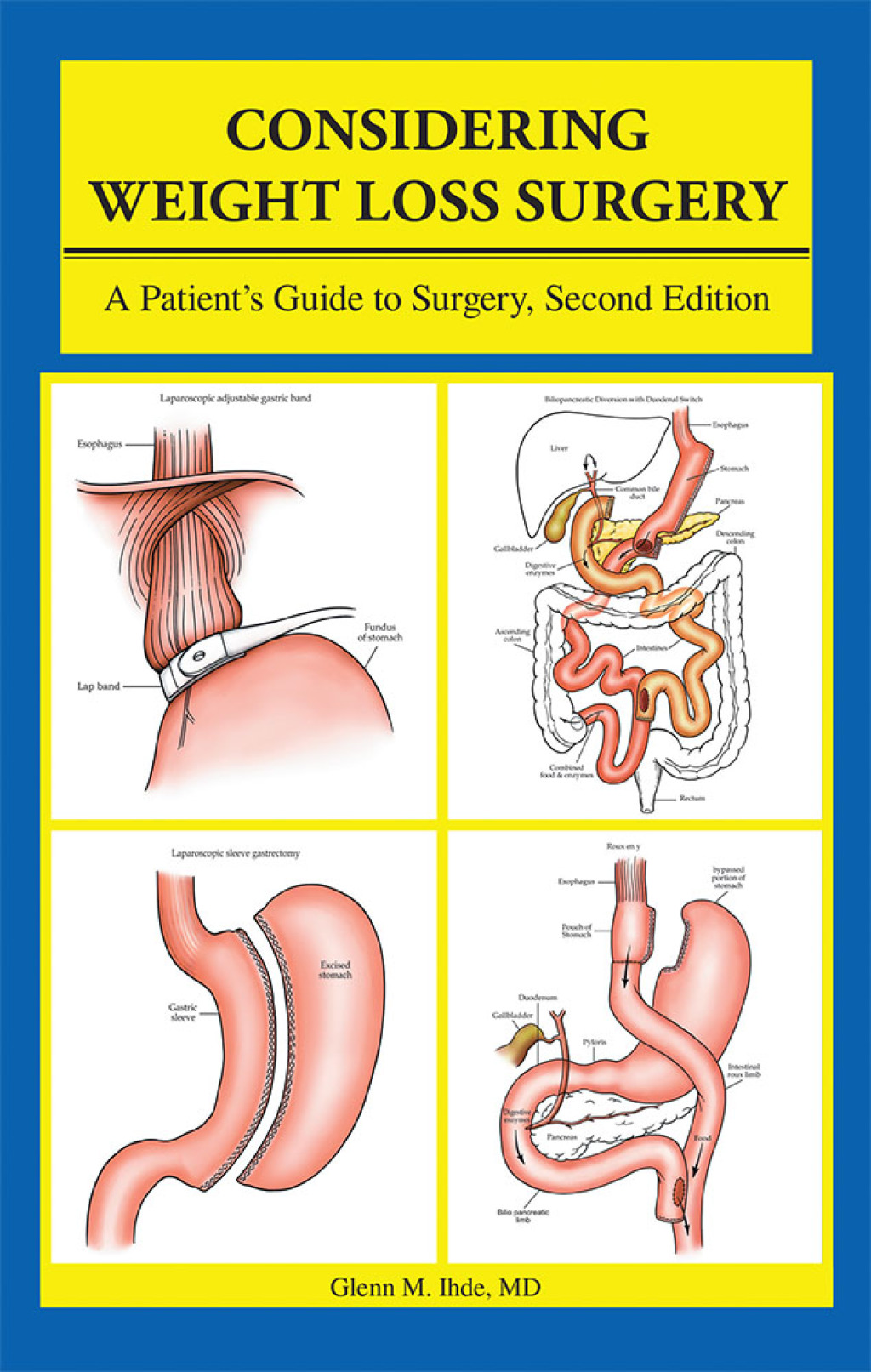 Considering Weight Loss Surgery A Patientâ€™s Guide to Surgery, Second Edition - (PDF/EPUB Version)