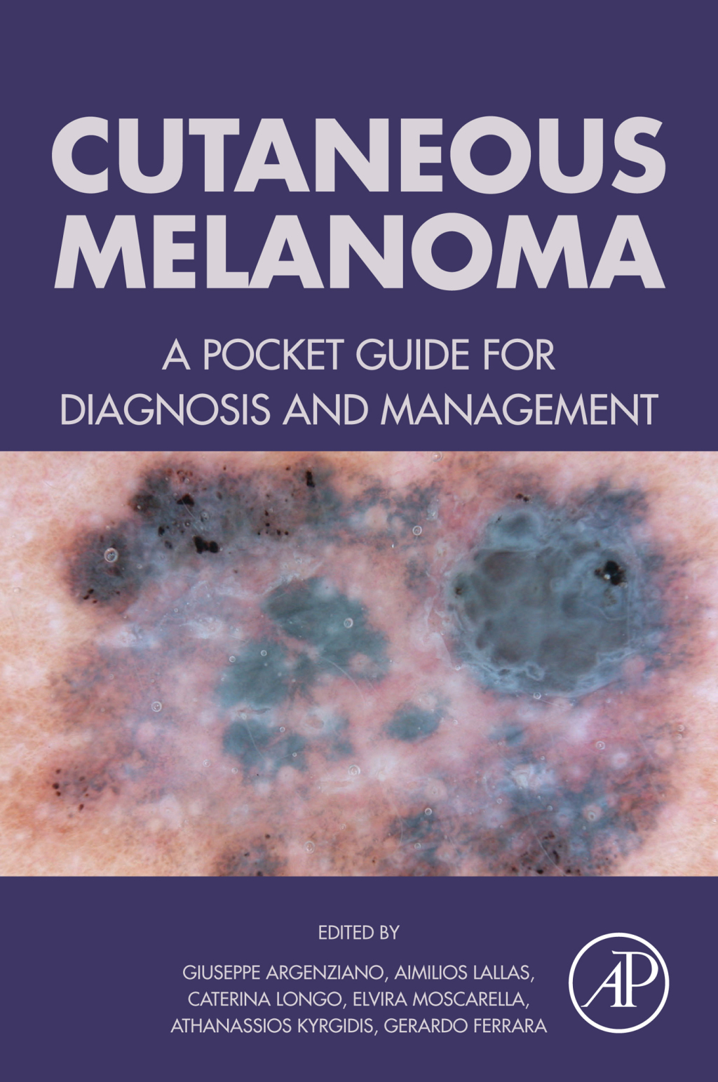 Cutaneous Melanoma A Pocket Guide for Diagnosis and Management â€“ PDF ...