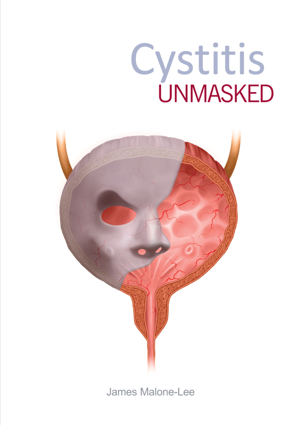 Cystitis unmasked 1st Edition - (PDF/EPUB Version)