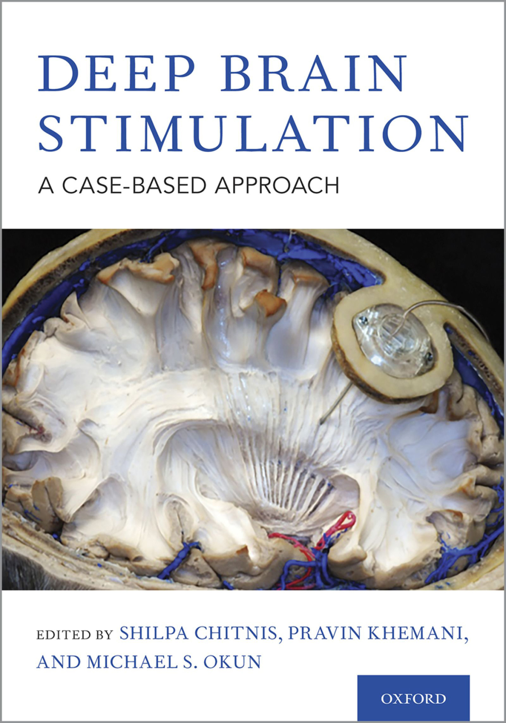 Deep Brain Stimulation A Case-based Approach 1st Edition â€“ PDF/EPUB ...