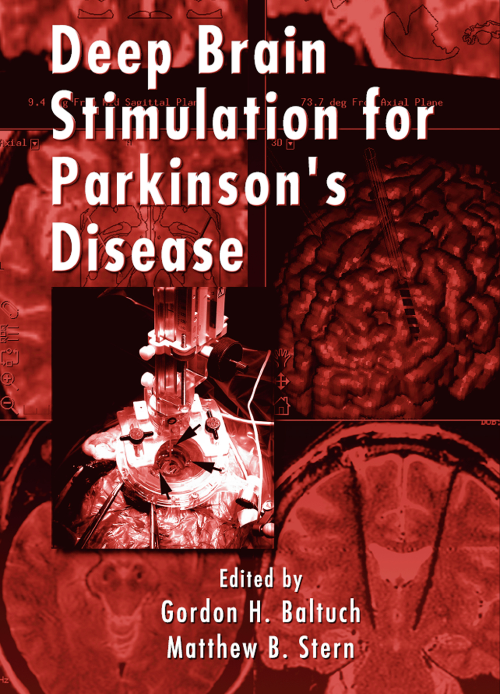 Deep Brain Stimulation for Parkinson’s Disease 1st Edition â€“ PDF/EPUB ...