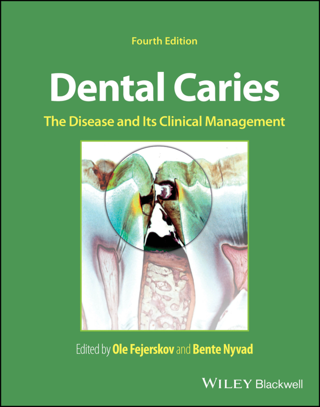 Dental Caries The Disease and its Clinical Management 4th Edition â ...