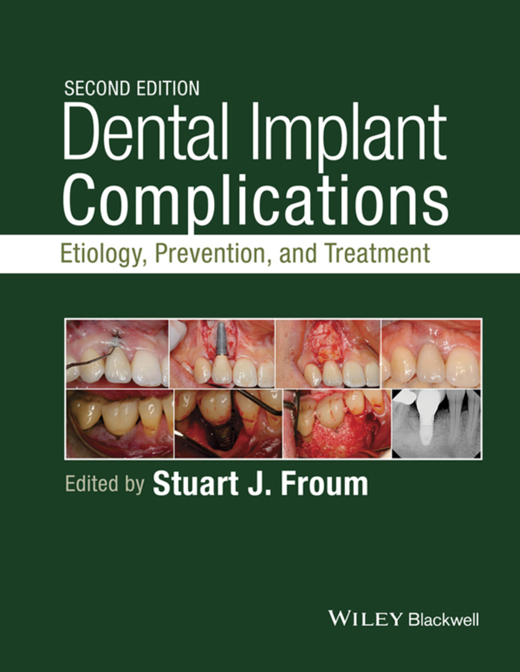 Dental Implant Complications: Etiology, Prevention, and Treatment 2nd Edition â€“ PDF/EPUB Version Downloadable