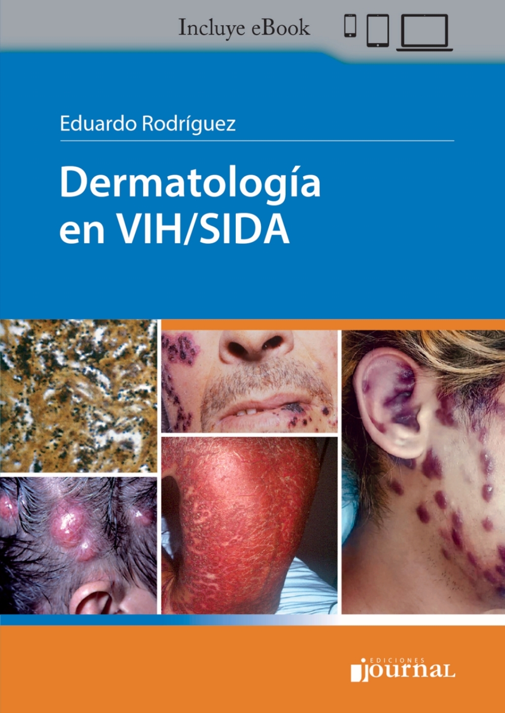 DermatologÃ­a en VIH/Sida 1st Edition - (PDF/EPUB Version)