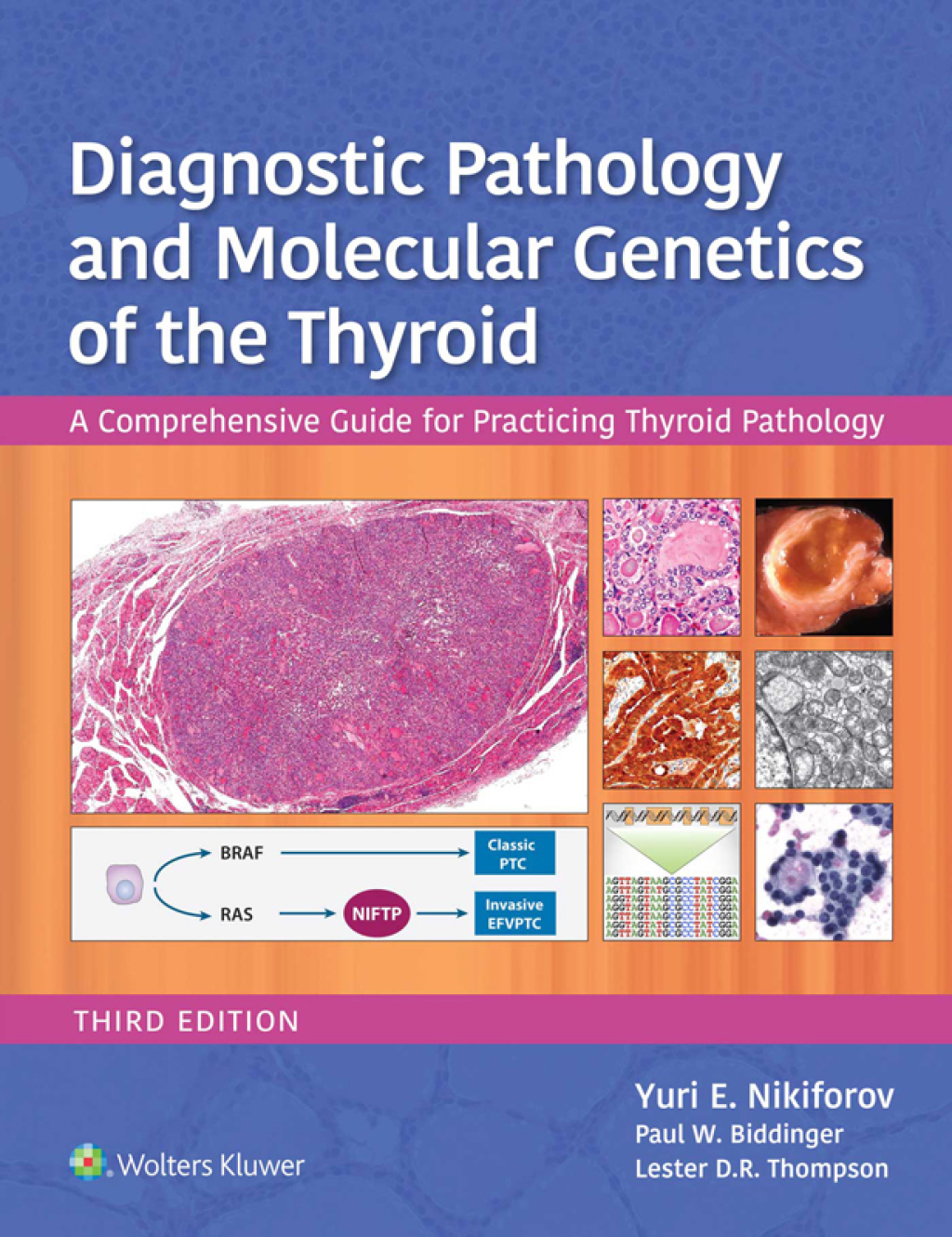 Diagnostic Pathology and Molecular Genetics of the Thyroid A ...