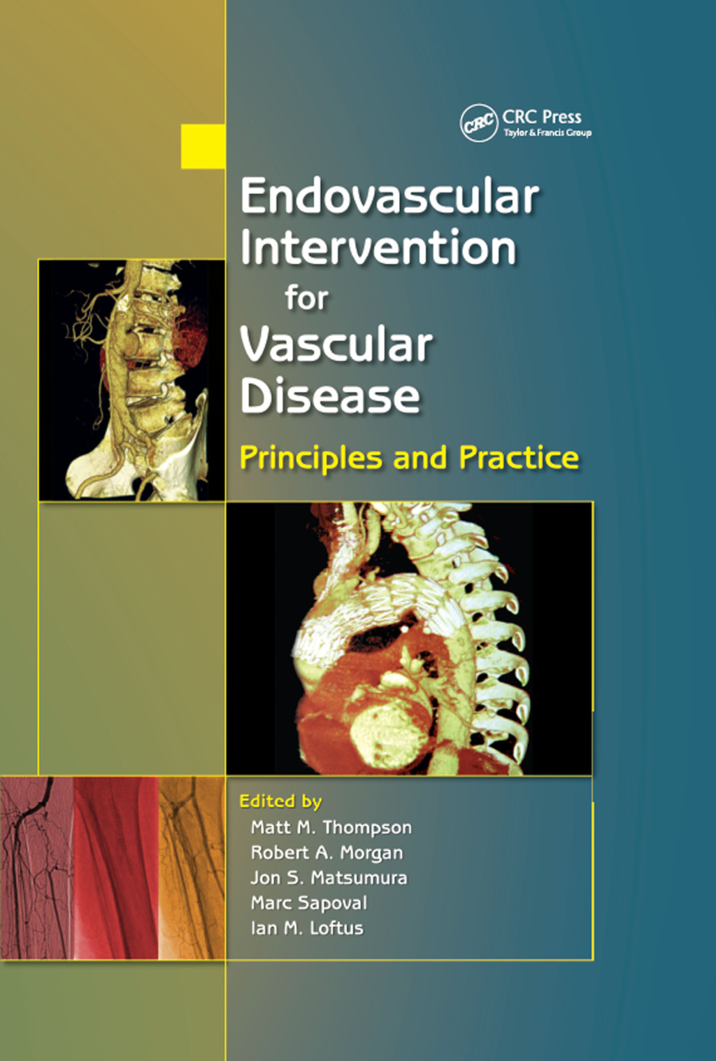 Endovascular Intervention for Vascular Disease Principles and Practice ...