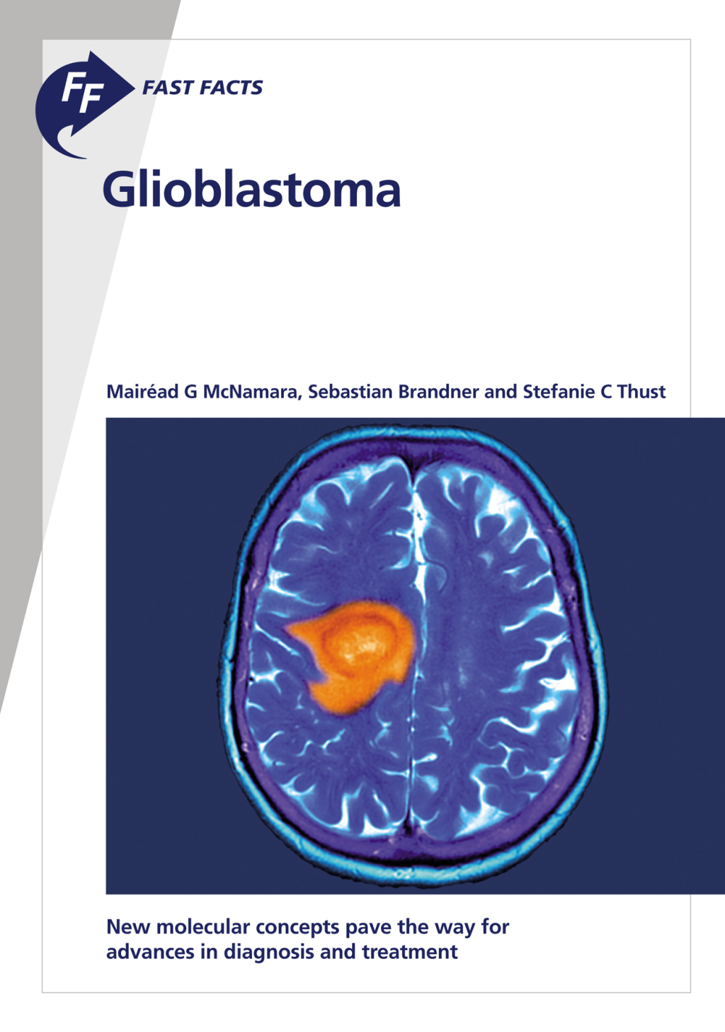 Fast Facts: Glioblastoma New molecular concepts pave the way for advances in diagnosis and treatment - (PDF/EPUB Version)