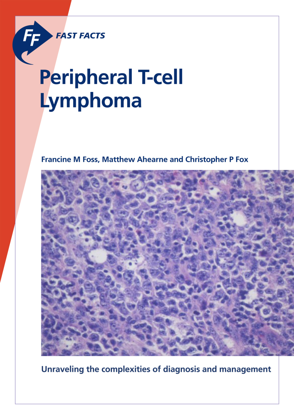 Fast Facts: Peripheral T-cell Lymphoma Unraveling the complexities of diagnosis and management - (PDF/EPUB Version)