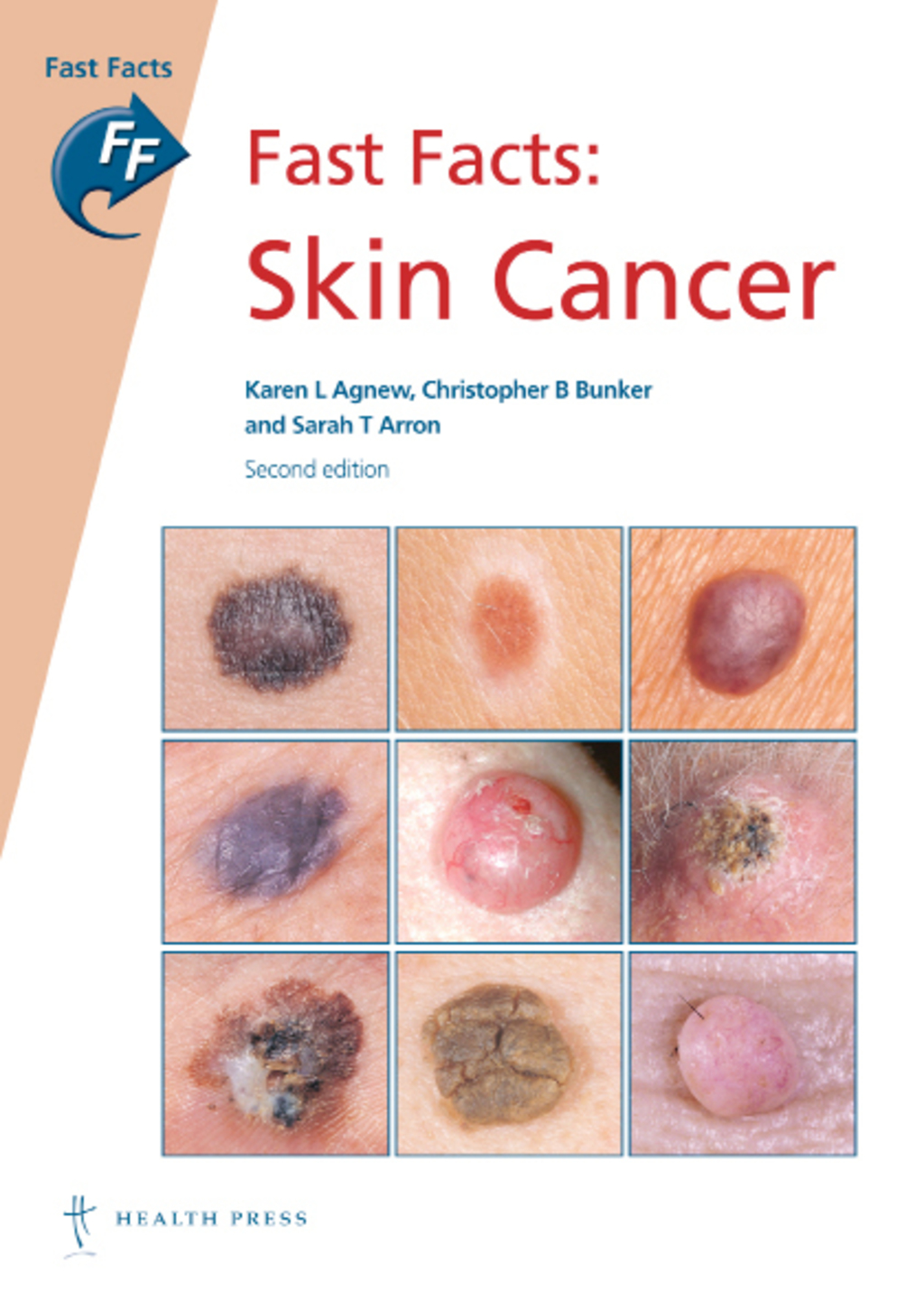 Fast Facts: Skin Cancer 2nd Edition - (PDF/EPUB Version)