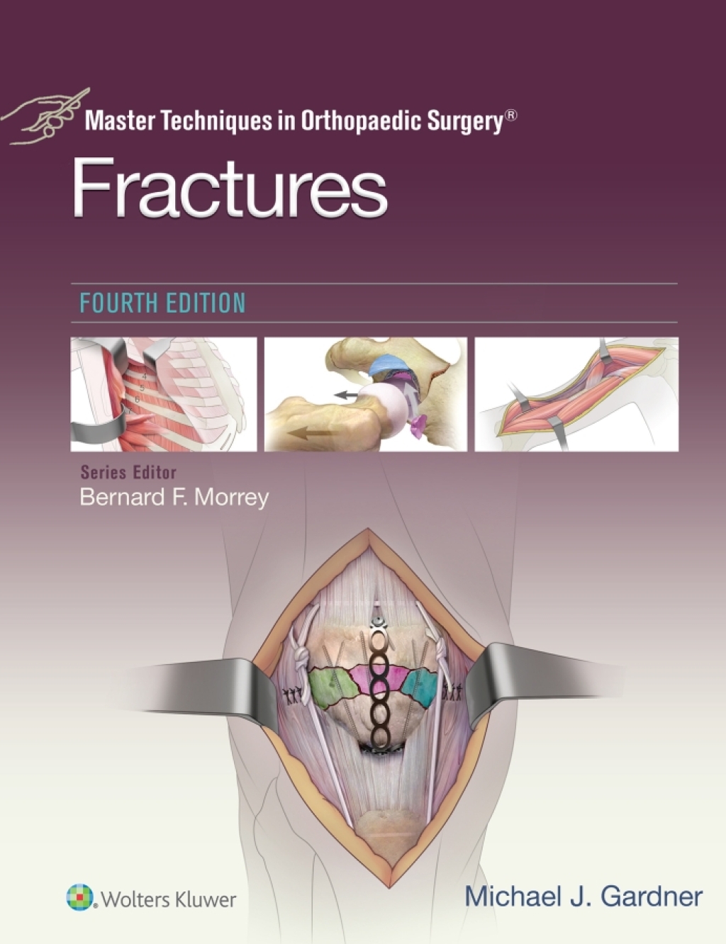 Master Techniques in Orthopaedic Surgery: Fractures 4th Edition â€“ PDF/EPUB Version Downloadable