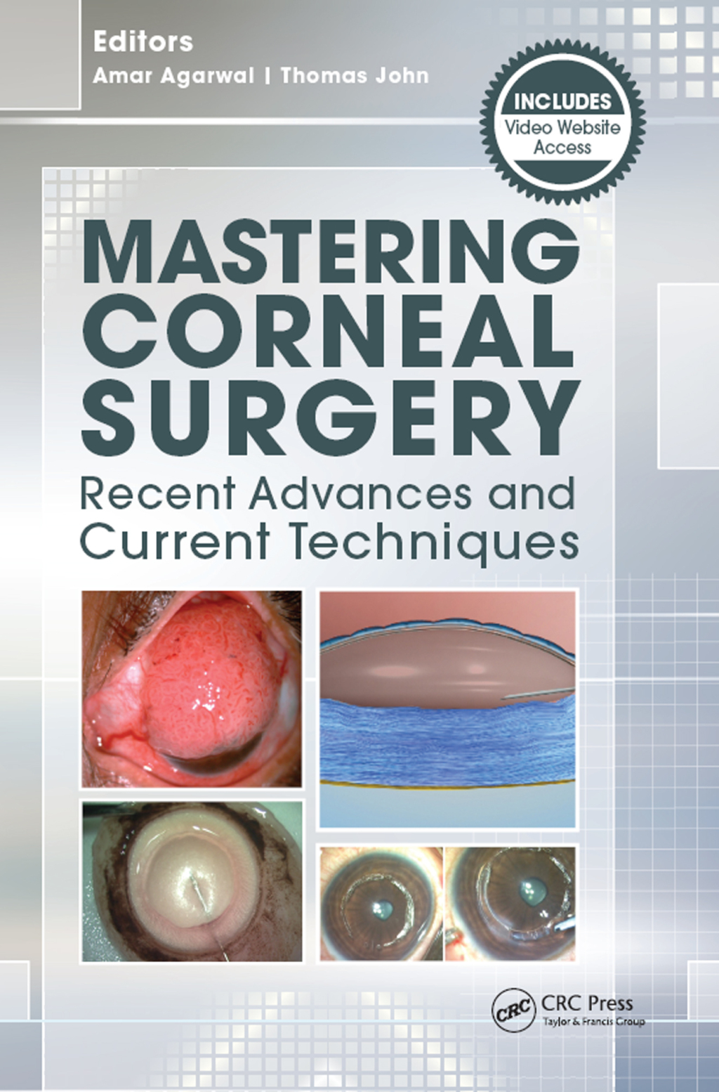 Mastering Corneal Surgery Recent Advances and Current Techniques 1st Edition â€“ PDF/EPUB Version Downloadable