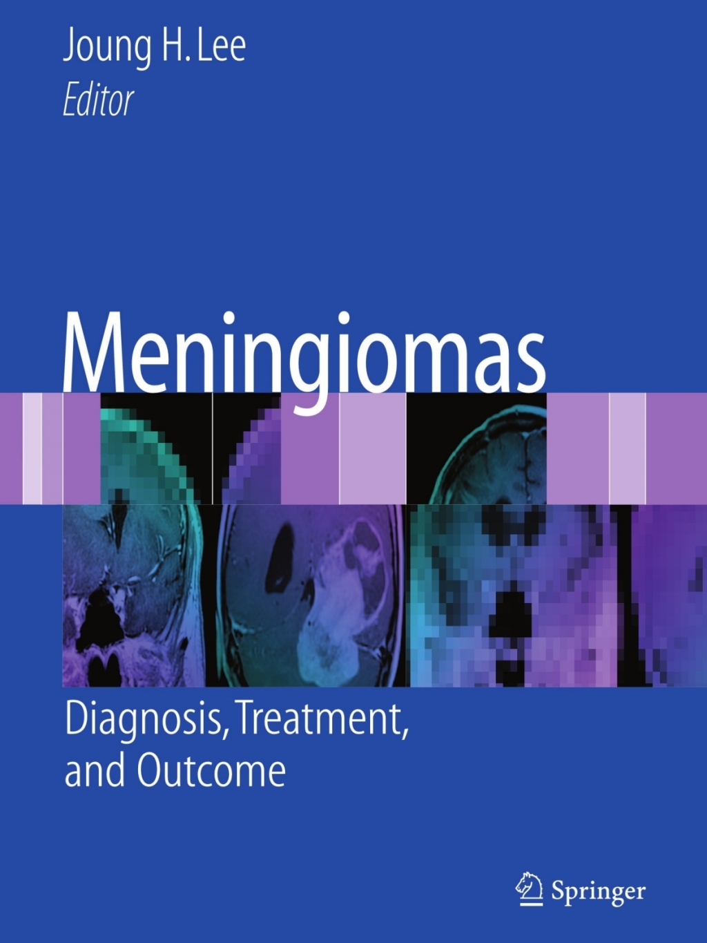 Meningiomas Diagnosis, Treatment, and Outcome  â€“ PDF/EPUB Version Downloadable