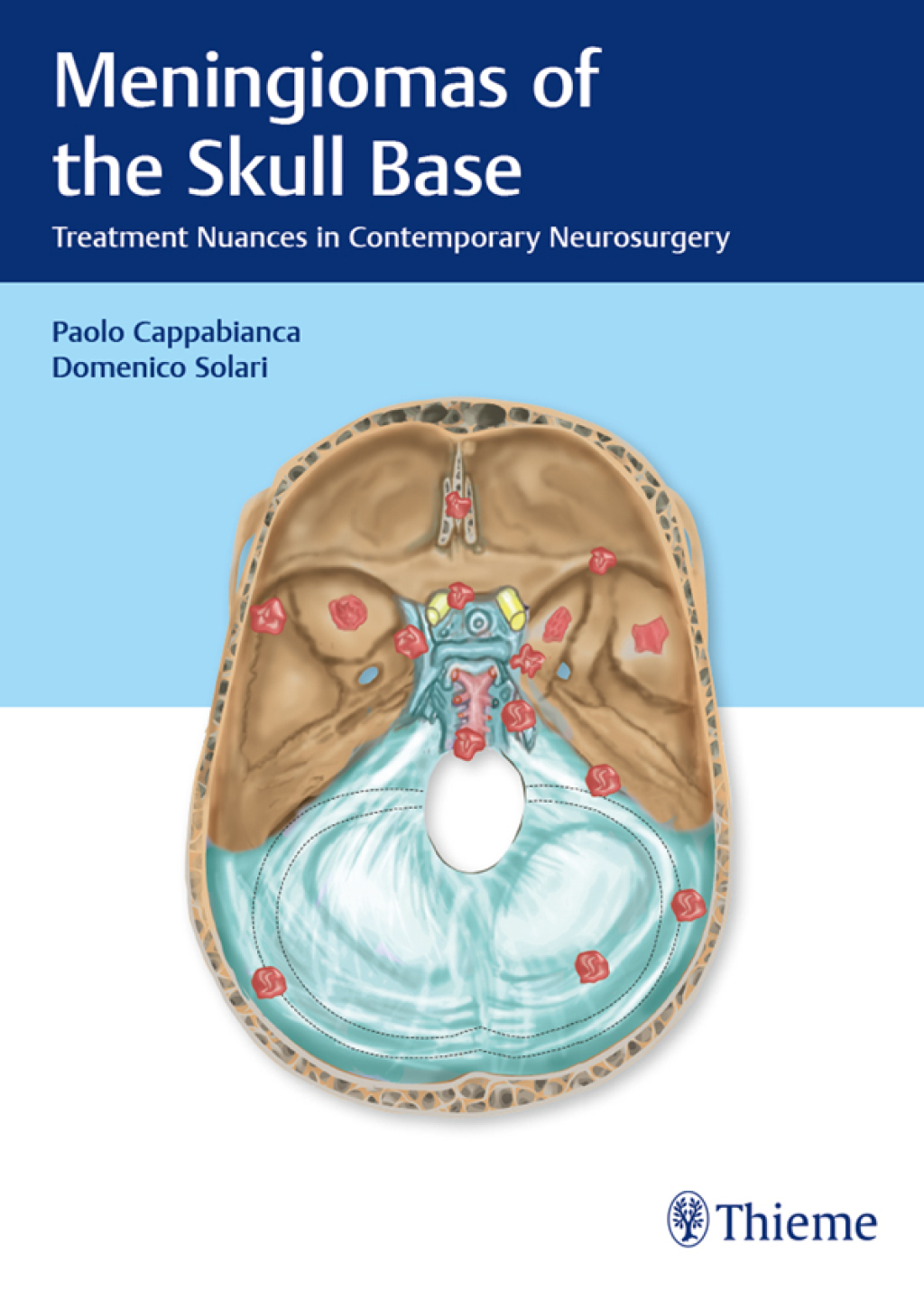 Meningiomas of the Skull Base Treatment Nuances in Contemporary Neurosurgery 1st Edition â€“ PDF/EPUB Version Downloadable