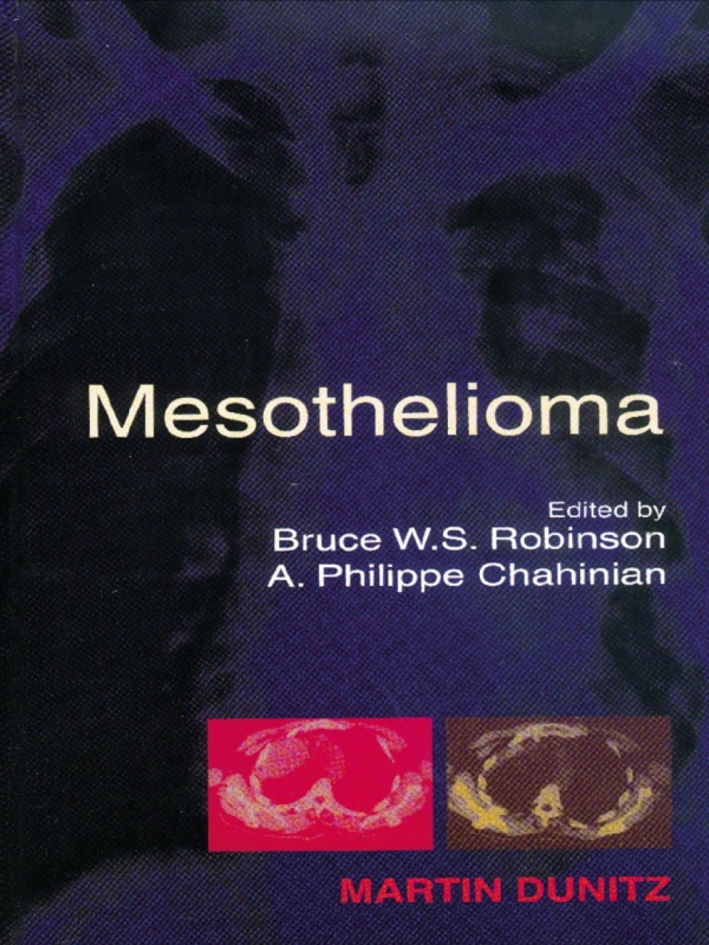Mesothelioma 1st Edition â€“ PDF/EPUB Version Downloadable
