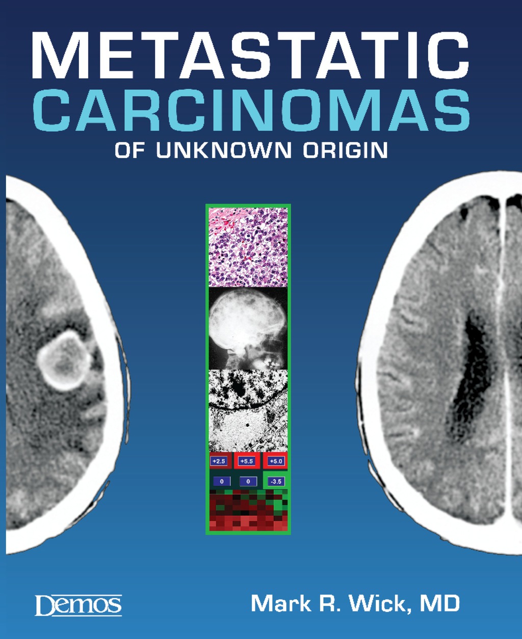 Metastatic Carcinomas of Unknown Origin 1st Edition â€“ PDF/EPUB Version Downloadable