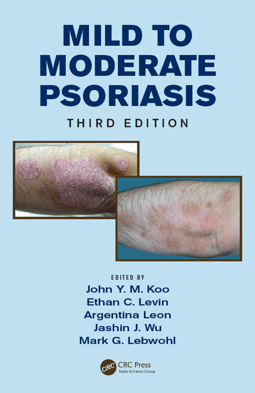 Mild to Moderate Psoriasis 3rd Edition â€“ PDF/EPUB Version Downloadable