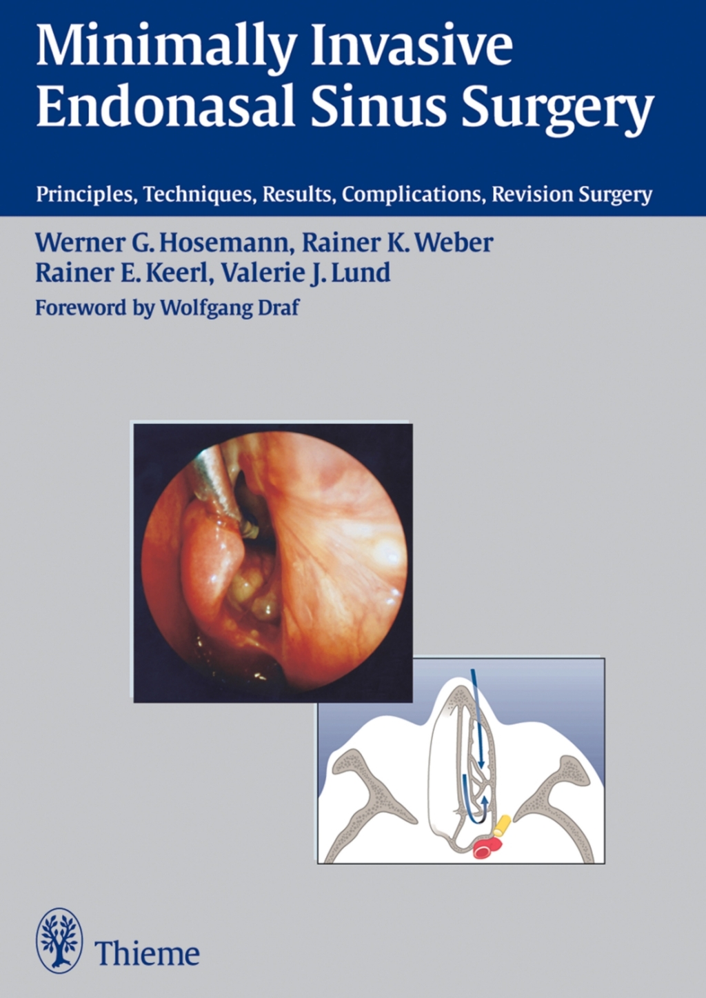 Minimally Invasive Endonasal Sinus Surgery Principles, Techniques, Results, Complications, Revision Surgery 1st Edition â€“ PDF/EPUB Version Downloadable