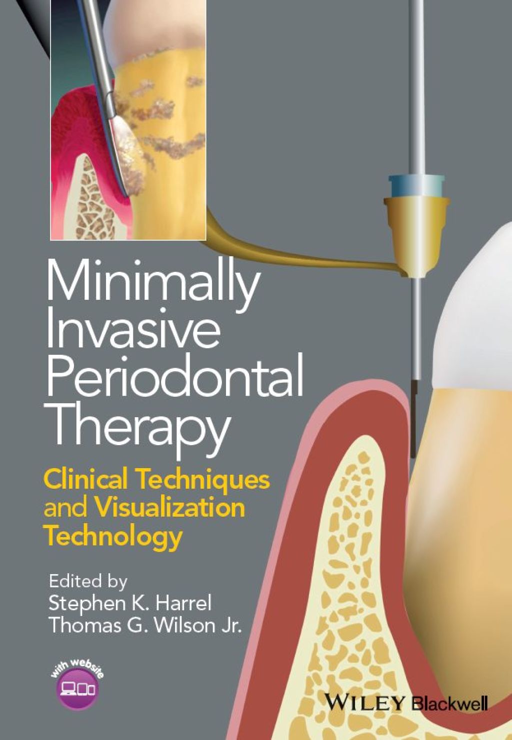 Minimally Invasive Periodontal Therapy Clinical Techniques and Visualization Technology 1st Edition â€“ PDF/EPUB Version Downloadable