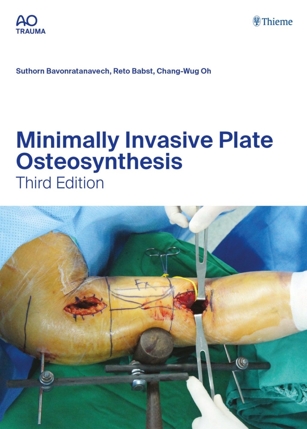 Minimally Invasive Plate Osteosynthesis 3rd Edition â€“ PDF/EPUB Version Downloadable