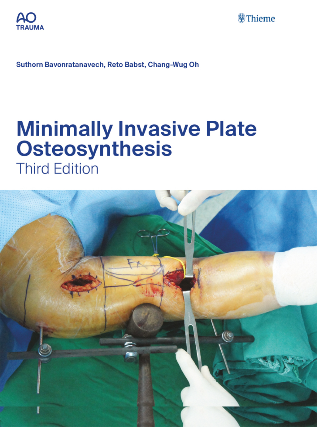 Minimally Invasive Plate Osteosynthesis 3rd Edition â€“ PDF/EPUB Version Downloadable
