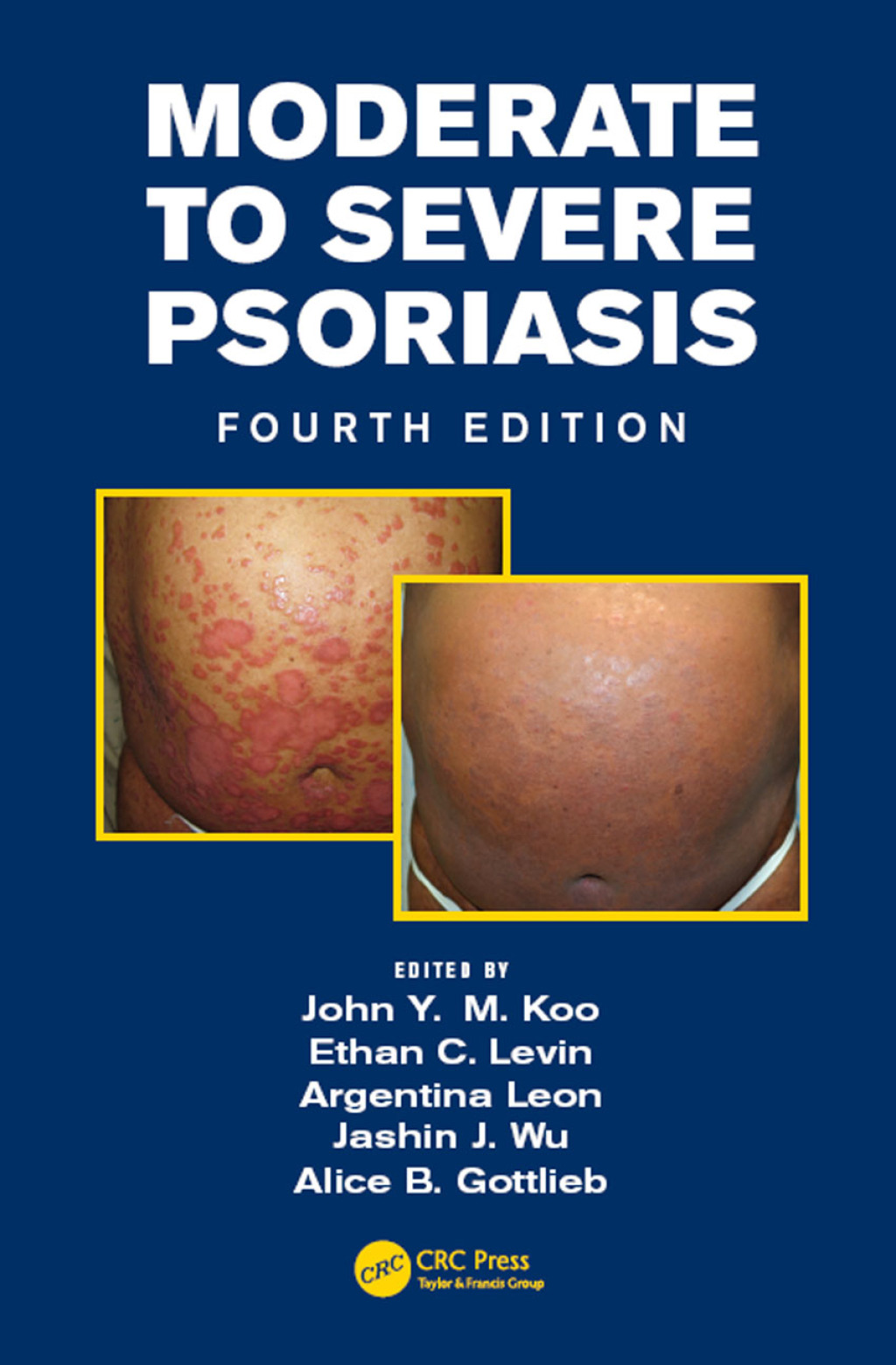 Moderate to Severe Psoriasis 4th Edition â€“ PDF/EPUB Version Downloadable