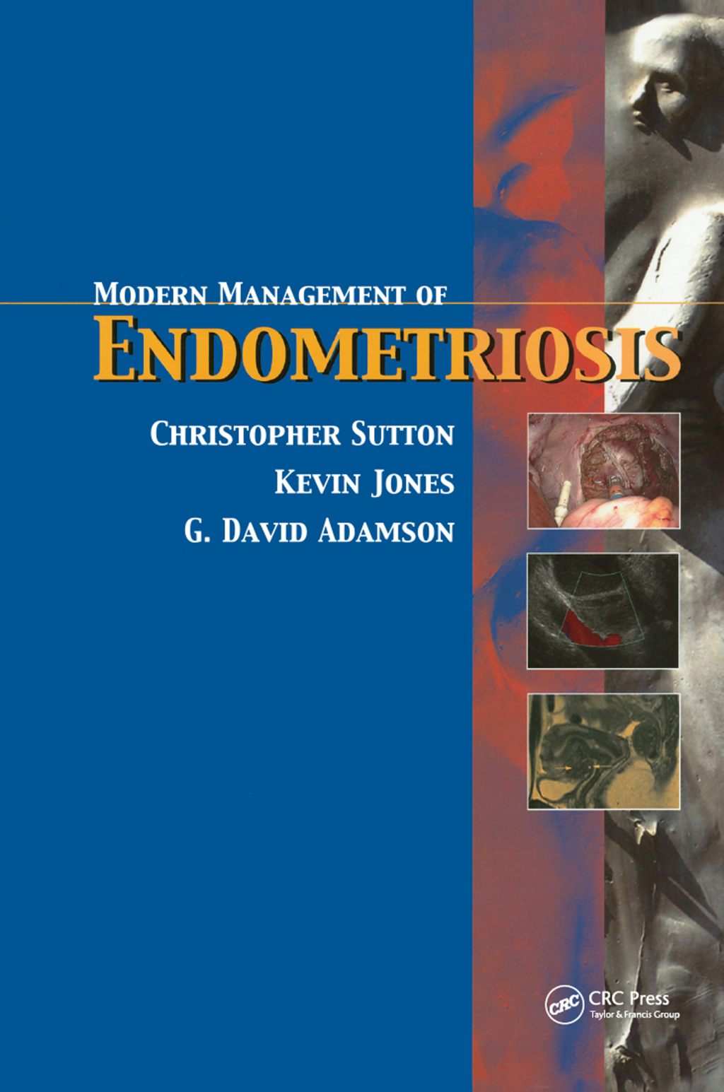 Modern Management of Endometriosis 1st Edition â€“ PDF/EPUB Version Downloadable