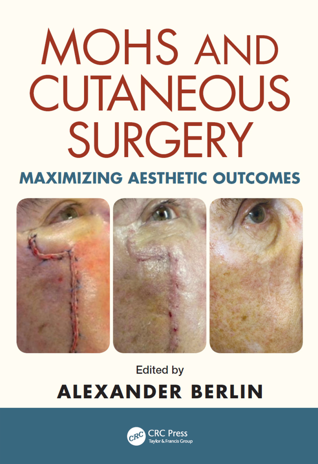 Mohs and Cutaneous Surgery Maximizing Aesthetic Outcomes 1st Edition â€“ PDF/EPUB Version Downloadable