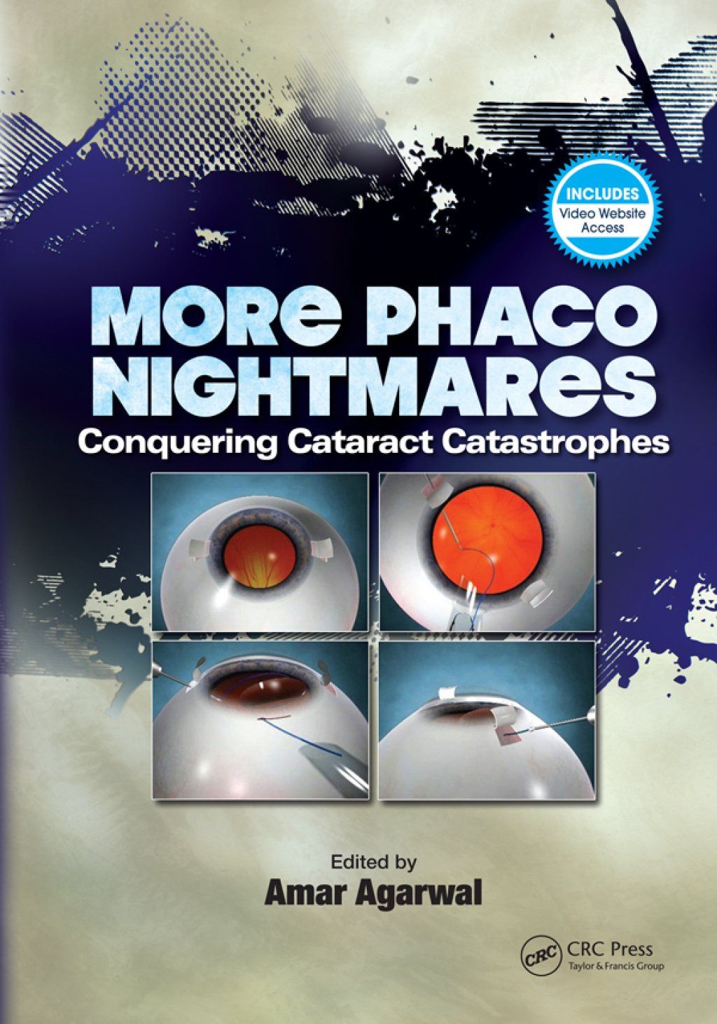 More Phaco Nightmares Conquering Cataract Catastrophes 1st Edition â€“ PDF/EPUB Version Downloadable
