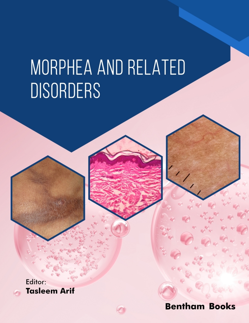 Morphea and Related Disorders 1st Edition â€“ PDF/EPUB Version Downloadable
