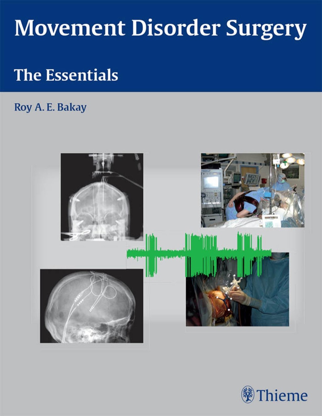 Movement Disorder Surgery The Essentials 1st Edition â€“ PDF/EPUB Version Downloadable