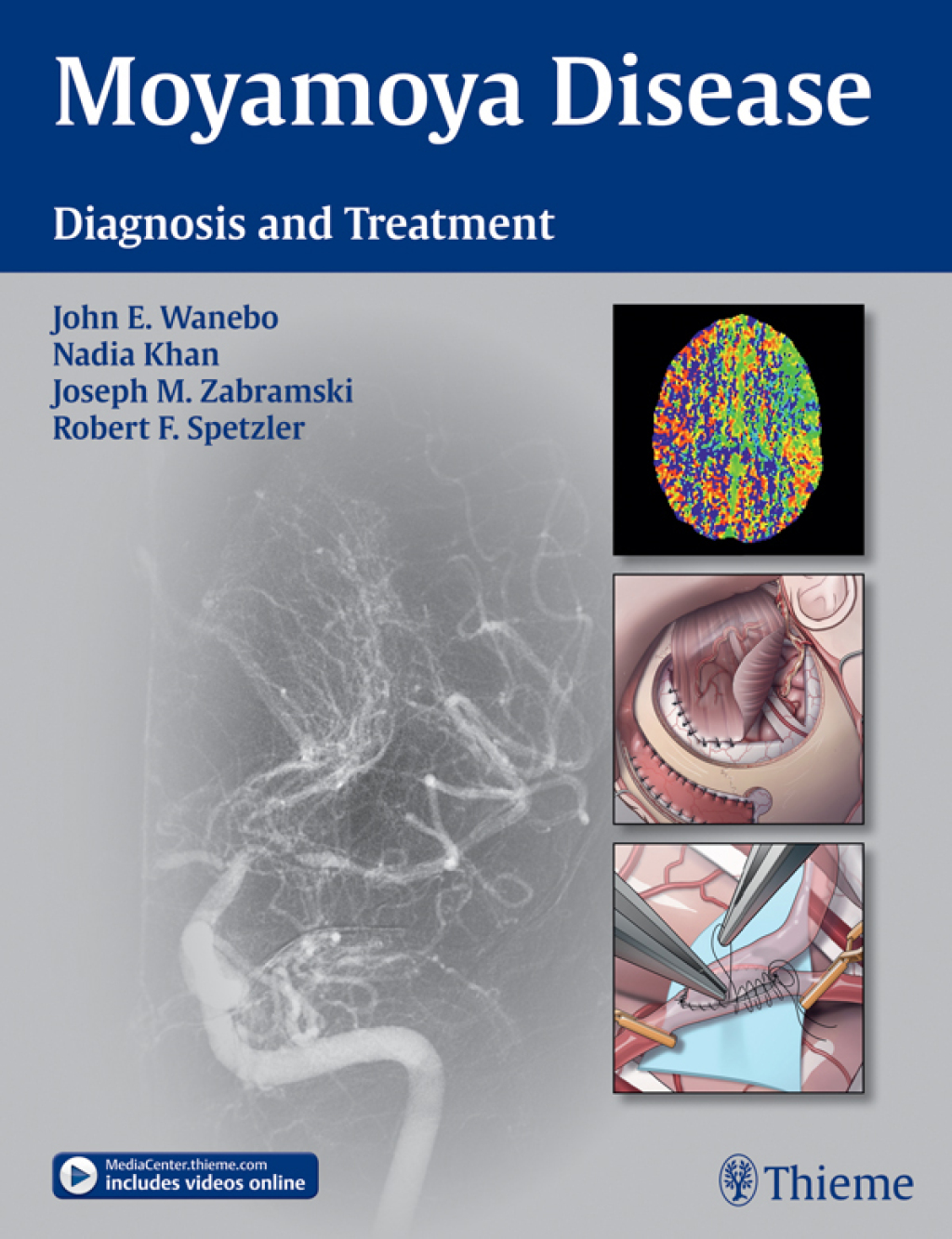 Moyamoya Disease Diagnosis and Treatment 1st Edition â€“ PDF/EPUB Version Downloadable