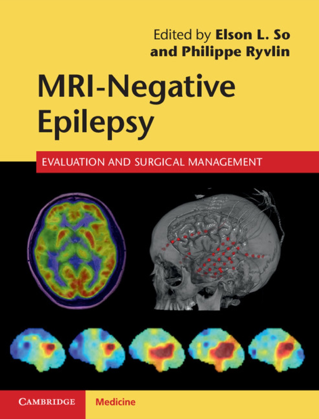 MRI-Negative Epilepsy Evaluation and Surgical Management 1st Edition â€“ PDF/EPUB Version Downloadable