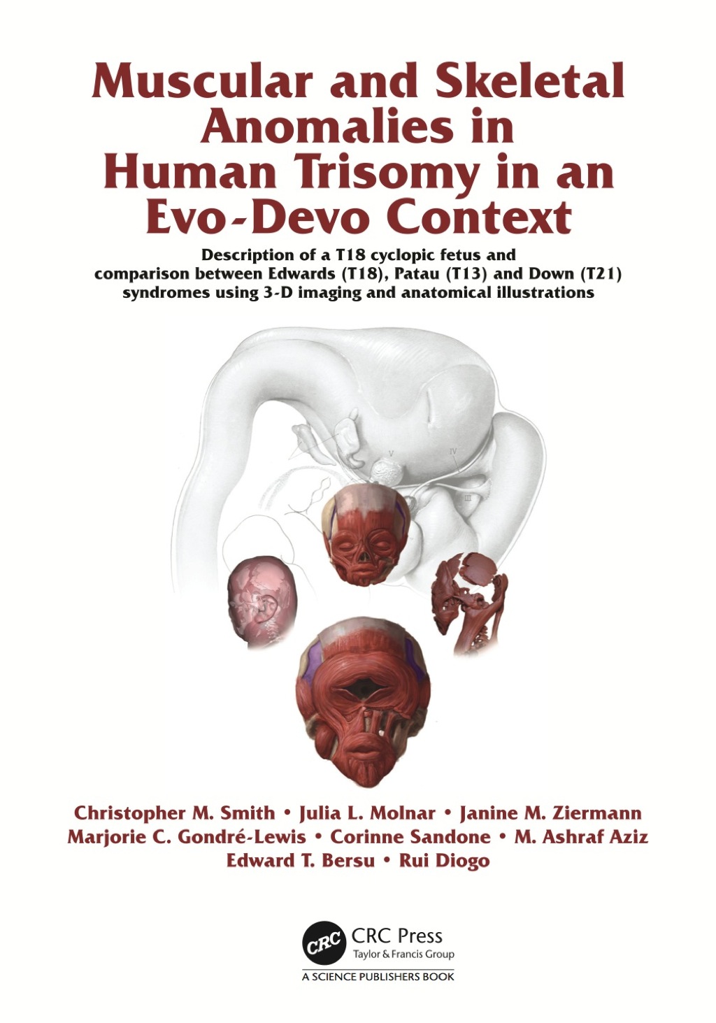 Muscular and Skeletal Anomalies in Human Trisomy in an Evo-Devo Context Description of a T18 Cyclopic Fetus and Comparison Between Edwards (T18), Patau (T13) and Down (T21) Syndromes Using 3-D Imaging and Anatomical Illustrations 1st Edition â€“ PDF/EPUB Version Downloadable