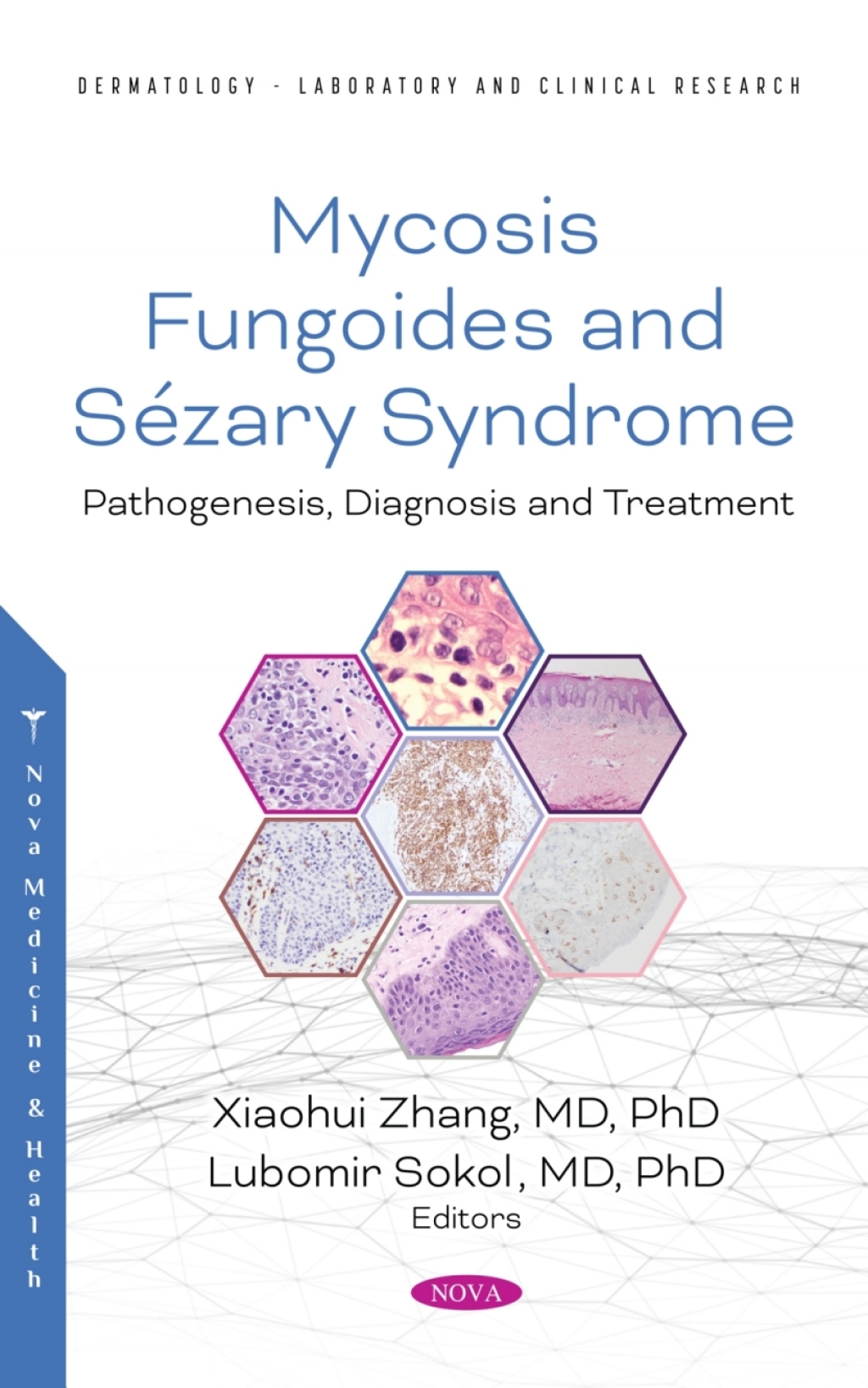 Mycosis Fungoides: Causes, Diagnosis and Treatment  â€“ PDF/EPUB Version Downloadable