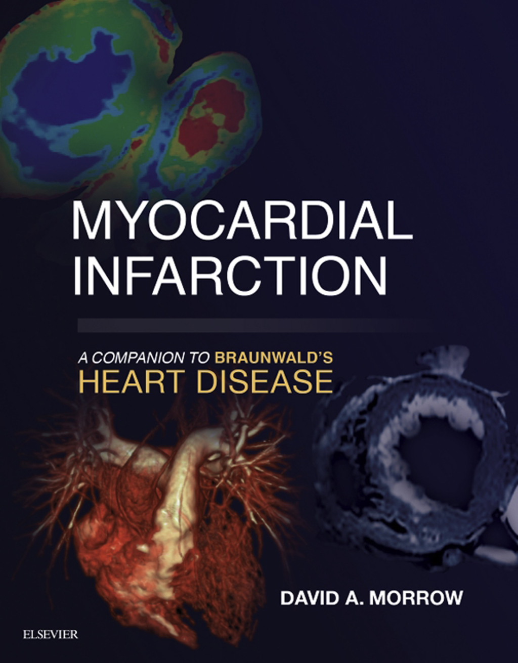 Myocardial Infarction: A Companion to Braunwald's Heart Disease 1st Edition â€“ PDF/EPUB Version Downloadable