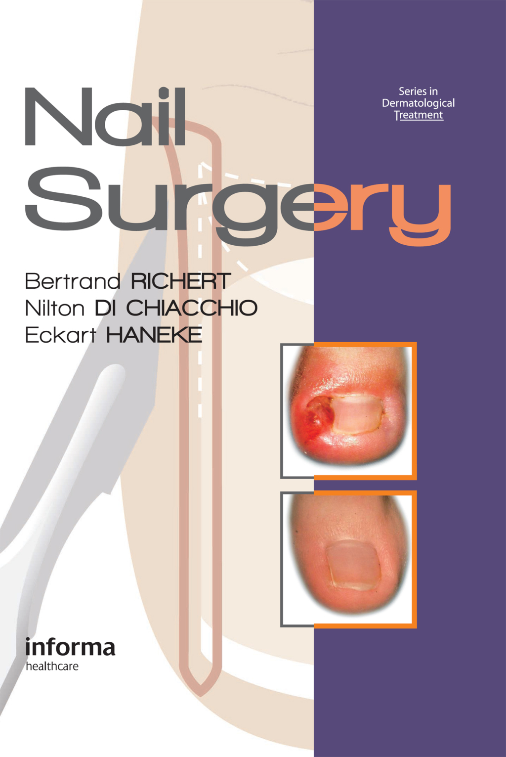 Nail Surgery 1st Edition â€“ PDF/EPUB Version Downloadable
