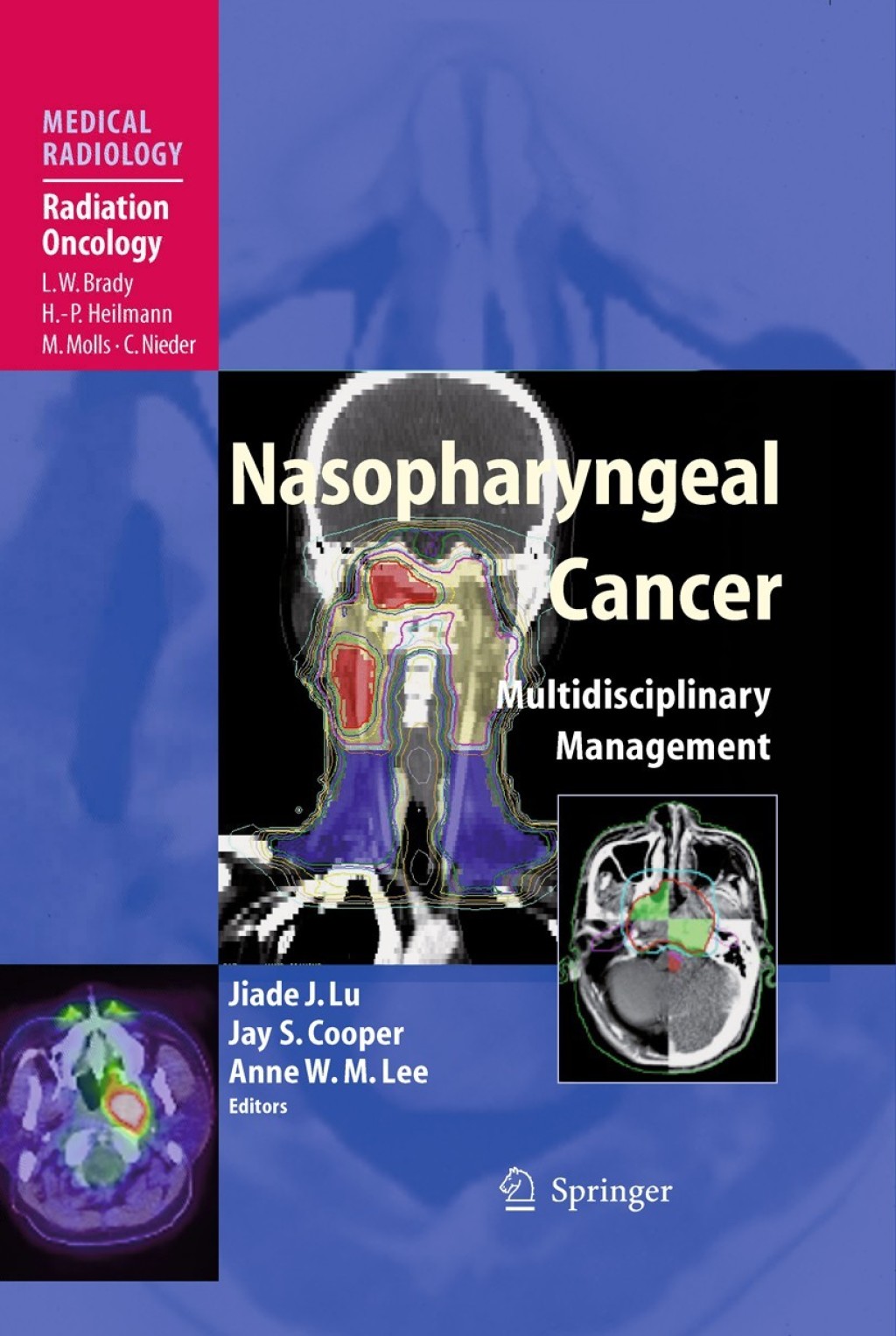 Nasopharyngeal Cancer Multidisciplinary Management 1st Edition â€“ PDF/EPUB Version Downloadable