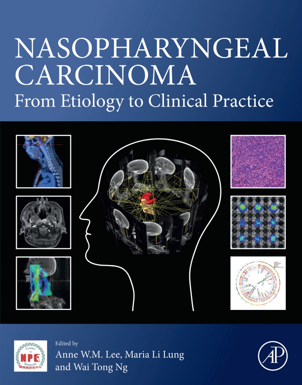 Nasopharyngeal Carcinoma From Etiology to Clinical Practice  â€“ PDF/EPUB Version Downloadable