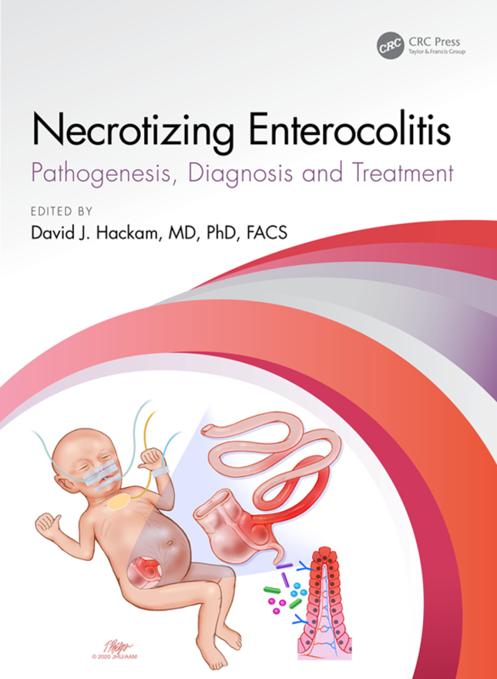 Necrotizing Enterocolitis pathogenesis, diagnosis and treatment 1st Edition â€“ PDF/EPUB Version Downloadable