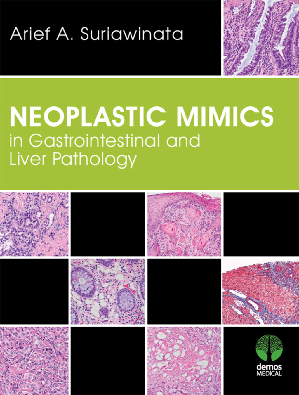 Neoplastic Mimics in Gastrointestinal and Liver Pathology 1st Edition â€“ PDF/EPUB Version Downloadable