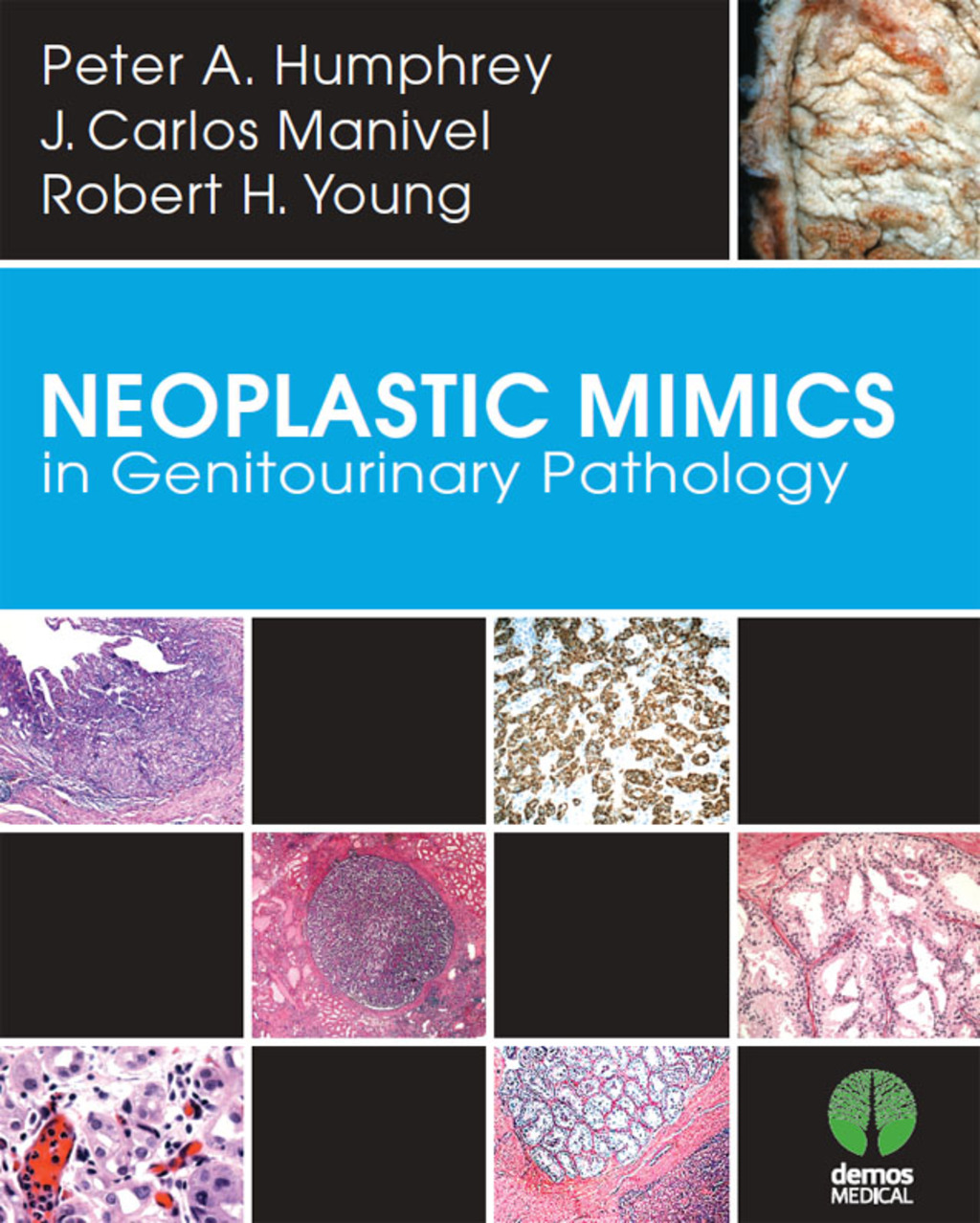 Neoplastic Mimics in Genitourinary Pathology 1st Edition â€“ PDF/EPUB Version Downloadable