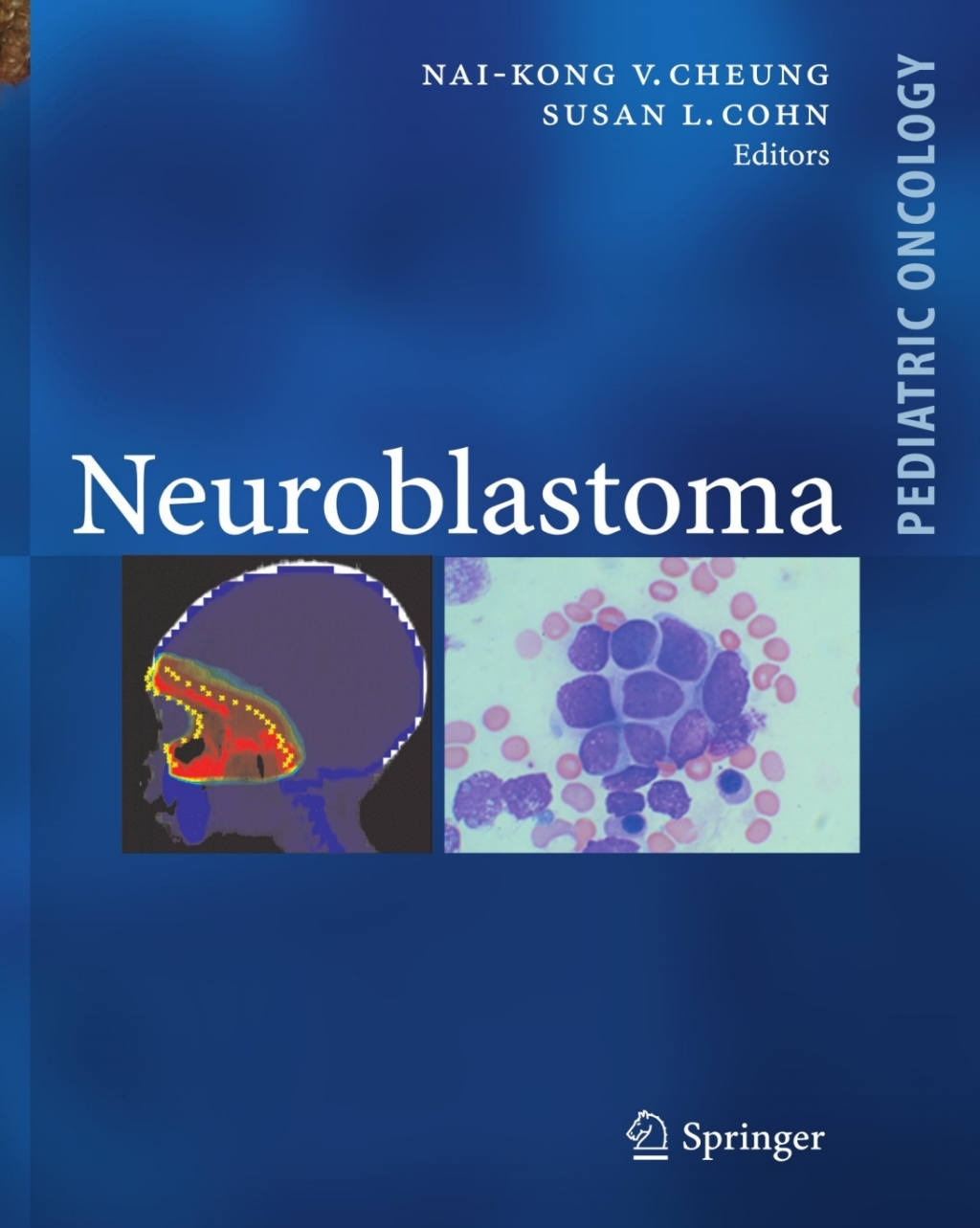 Neuroblastoma 1st Edition â€“ PDF/EPUB Version Downloadable