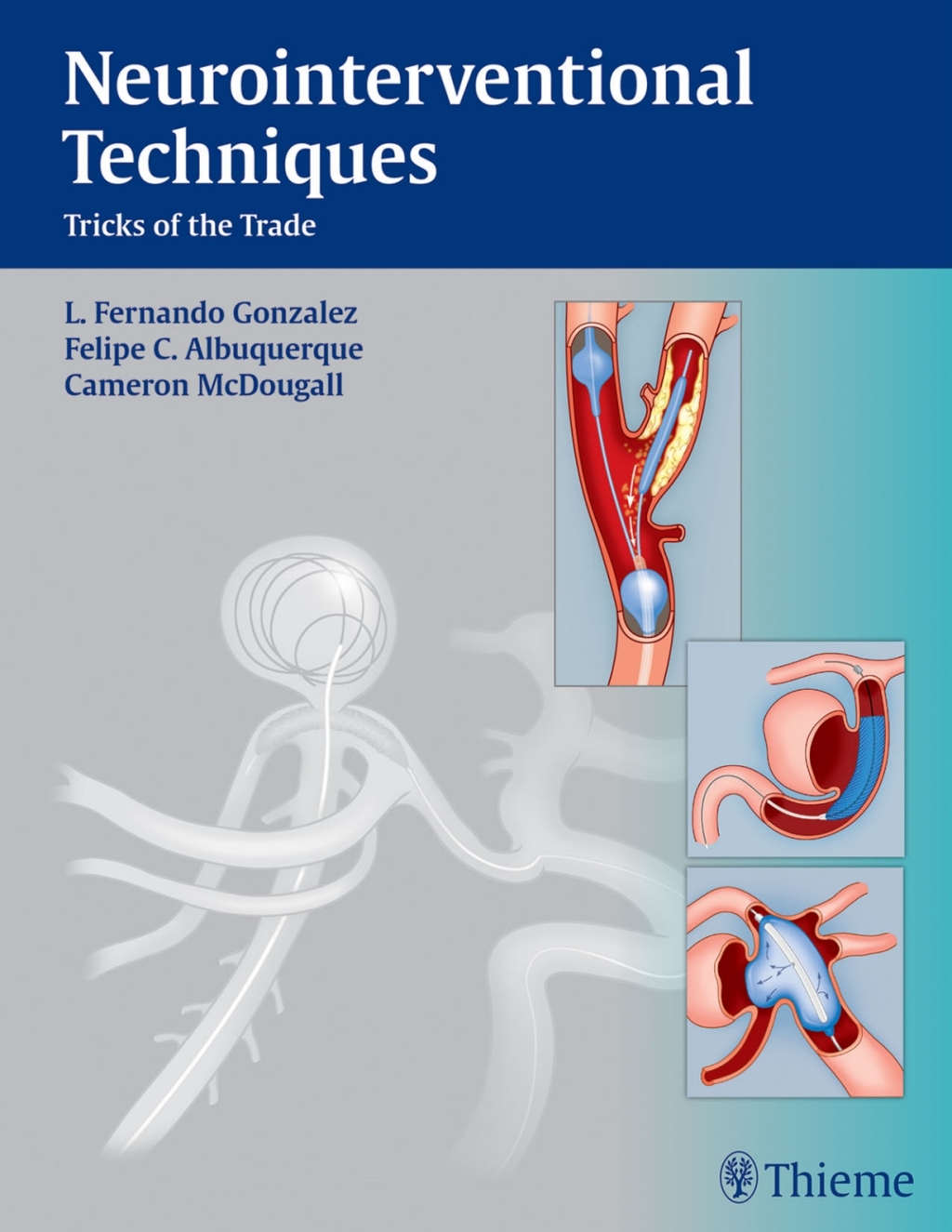 Neurointerventional Techniques Tricks of the Trade 1st Edition â€“ PDF/EPUB Version Downloadable