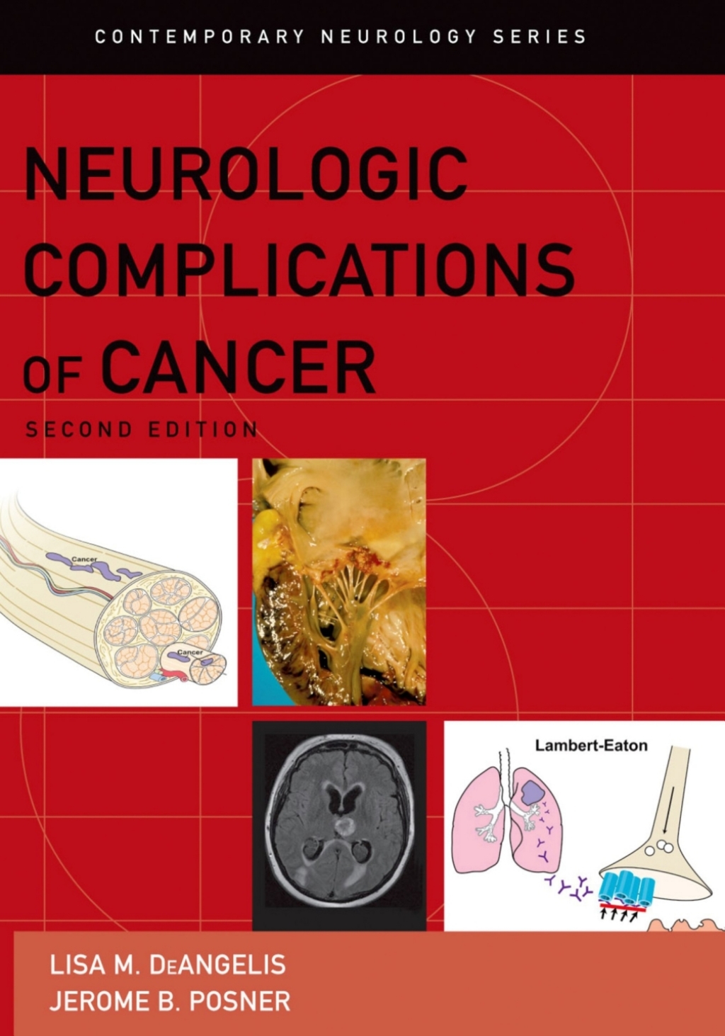 Neurologic Complications of Cancer 2nd Edition â€“ PDF/EPUB Version Downloadable