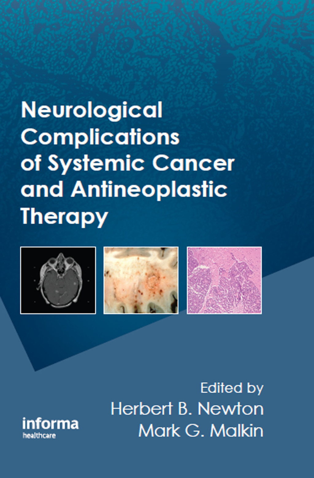 Neurological Complications of Systemic Cancer and Antineoplastic Therapy 1st Edition â€“ PDF/EPUB Version Downloadable